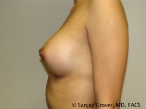 Breast Augmentation Before and After 110 | Sanjay Grover MD FACS