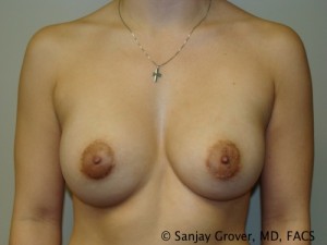 Breast Augmentation Before and After 112 | Sanjay Grover MD FACS