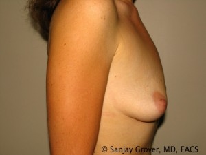 Breast Augmentation Before and After 113 | Sanjay Grover MD FACS