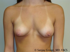 Breast Augmentation Before and After 75 | Sanjay Grover MD FACS