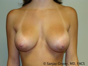 Breast Augmentation Before and After | Grover Aesthetics