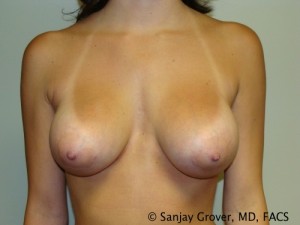 Breast Augmentation Before and After 114 | Sanjay Grover MD FACS