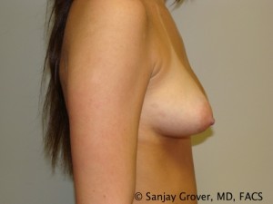 Breast Augmentation Before and After 114 | Grover Aesthetics
