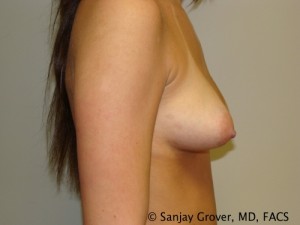 Breast Augmentation Before and After 114 | Sanjay Grover MD FACS