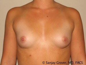 Breast Augmentation Before and After 166 | Sanjay Grover MD FACS