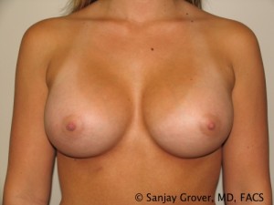 Breast Augmentation Before and After | Grover Aesthetics
