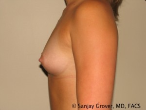 Breast Augmentation Before and After 115 | Grover Aesthetics