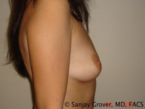 Breast Augmentation Before and After 116 | Sanjay Grover MD FACS