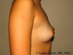 Breast Augmentation Before and After 116 | Grover Aesthetics