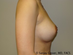 Breast Augmentation Before and After 116 | Grover Aesthetics