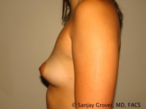 Breast Augmentation Before and After 116 | Grover Aesthetics
