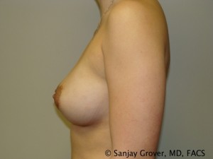 Breast Augmentation Before and After 116 | Grover Aesthetics