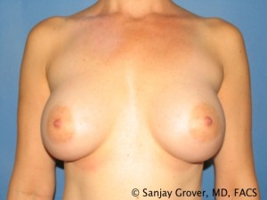 Breast Augmentation Before and After 117 | Sanjay Grover MD FACS
