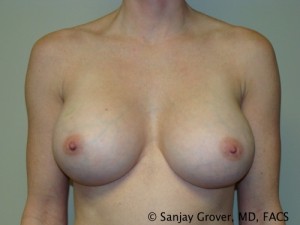 Breast Augmentation Before and After | Sanjay Grover MD FACS