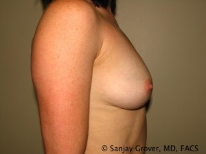 Breast Augmentation Before and After 117 | Grover Aesthetics