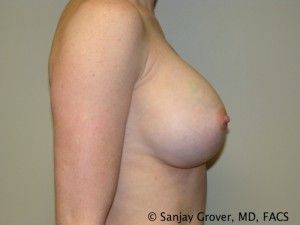 Breast Augmentation Before and After 117 | Grover Aesthetics