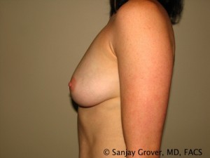 Breast Augmentation Before and After 117 | Grover Aesthetics