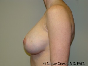 Breast Augmentation Before and After 117 | Grover Aesthetics