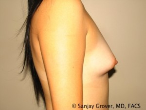 Breast Augmentation Before and After 118 | Grover Aesthetics