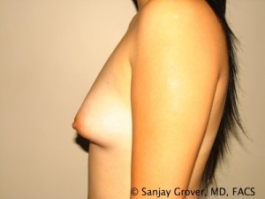 Breast Augmentation Before and After 118 | Grover Aesthetics