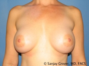 Breast Augmentation Before and After 120 | Sanjay Grover MD FACS