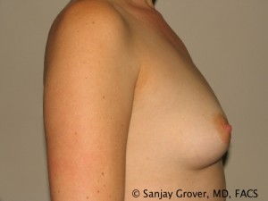 Breast Augmentation Before and After 120 | Grover Aesthetics