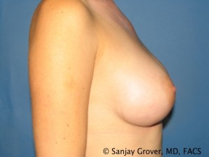 Breast Augmentation Before and After 120 | Grover Aesthetics