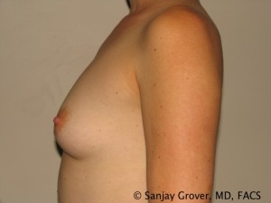 Breast Augmentation Before and After 120 | Grover Aesthetics