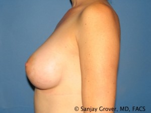Breast Augmentation Before and After 120 | Grover Aesthetics