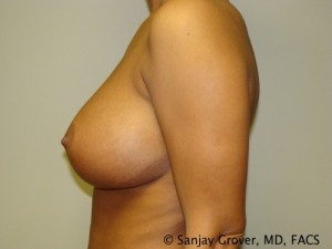 Breast Augmentation Before and After 121 | Grover Aesthetics