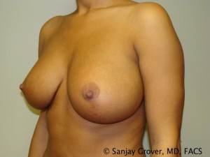 Breast Augmentation Before and After 121 | Sanjay Grover MD FACS