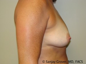 Breast Augmentation Before and After 122 | Grover Aesthetics