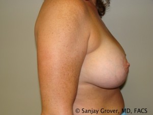 Breast Augmentation Before and After 122 | Grover Aesthetics