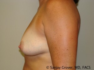 Breast Augmentation Before and After 122 | Grover Aesthetics