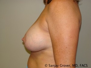 Breast Augmentation Before and After 122 | Grover Aesthetics