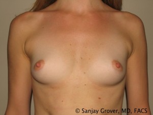 Breast Augmentation Before and After | Grover Aesthetics