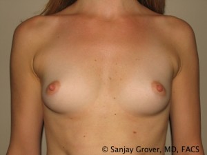 Breast Augmentation Before and After 189 | Sanjay Grover MD FACS