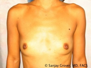 Breast Augmentation Before and After | Grover Aesthetics