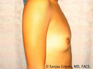 Breast Augmentation Before and After 124 | Grover Aesthetics