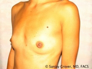 Breast Augmentation Before and After 124 | Grover Aesthetics