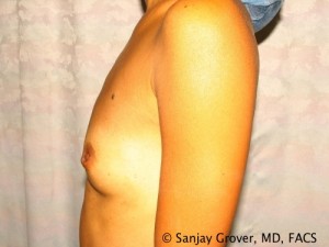 Breast Augmentation Before and After 124 | Grover Aesthetics