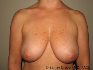 Breast Augmentation Before and After | Grover Aesthetics