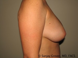 Breast Augmentation Before and After 125 | Sanjay Grover MD FACS