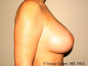 Breast Augmentation Before and After 125 | Sanjay Grover MD FACS