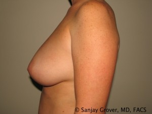 Breast Augmentation Before and After 125 | Grover Aesthetics
