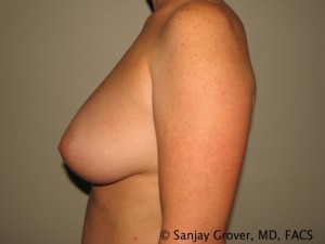 Breast Augmentation Before and After 125 | Sanjay Grover MD FACS