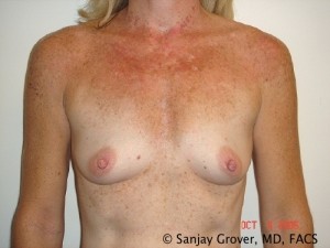 Breast Augmentation Before and After | Grover Aesthetics