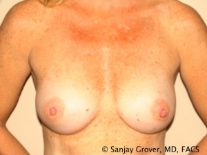 Breast Augmentation Before and After | Grover Aesthetics