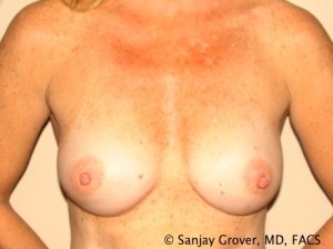 Breast Augmentation Before and After | Sanjay Grover MD FACS