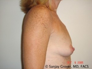 Breast Augmentation Before and After 126 | Grover Aesthetics
